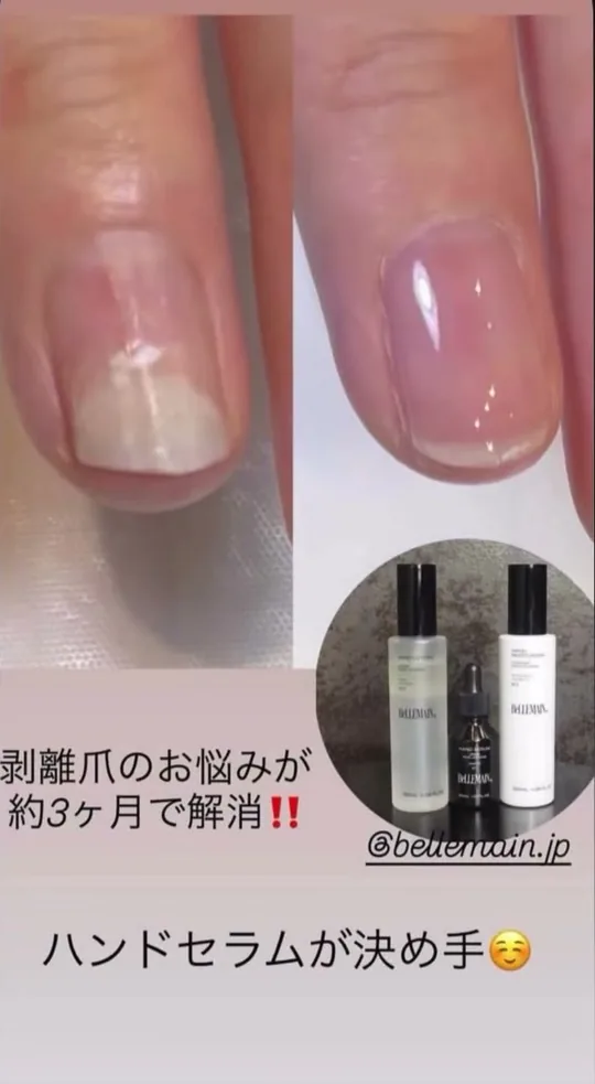 ベリュマン使用例 CASE 04(使用前・使用後)