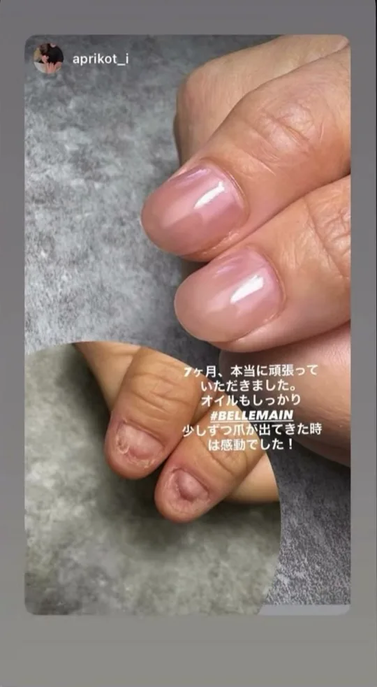 ベリュマン使用例 CASE 05（使用前・使用後）