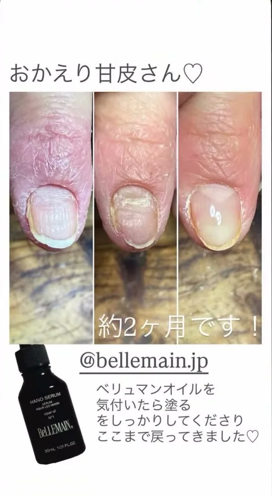 ベリュマン使用例 CASE 06（使用前・使用後）
