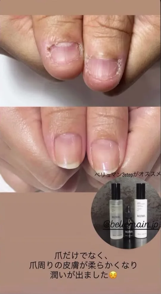 ベリュマン使用例 CASE 09(使用前・使用後)