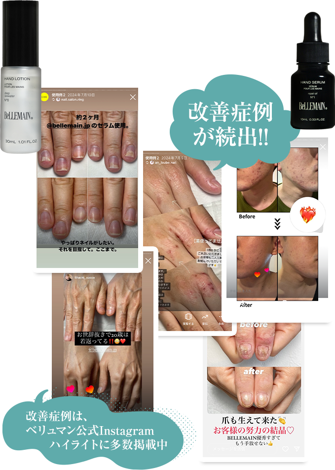 改善症例が続出!!改善症例は、ベリュマン公式Instagramハイライトに多数掲載中